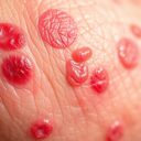 Bakteryjne zapalenie skóry – objawy, przyczyny i leczenie