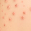 Rogowacenie okołomieszkowe: Przyczyny, objawy i leczenie